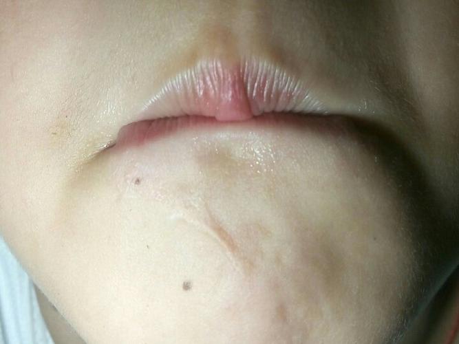 最有福气的下巴伤疤