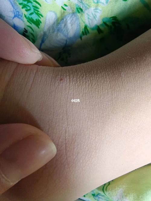 脚踝长痣的人容易患有前度恐惧症吗