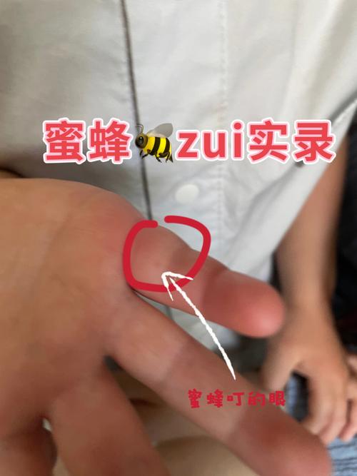 被蜜蜂蛰了是好兆头吗