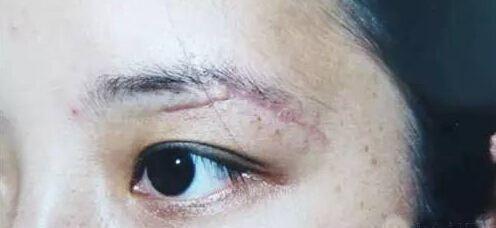 眉毛上有疤的人运势如何