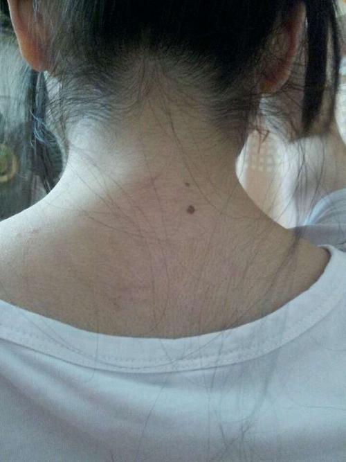 脖子后面有痣孝顺吗