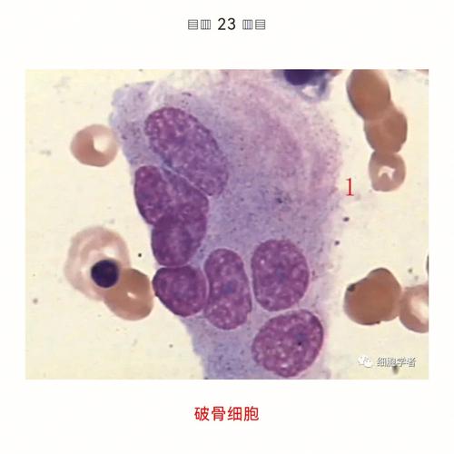 骨髓破是克谁呢?骨髓破怎么查?