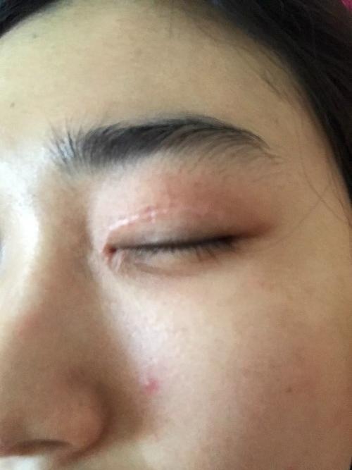 眼睛上的疤痕意味着什么?